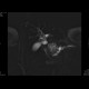 Adenocarcinoma of biliary duct: MRI - Magnetic Resonance Imaging
